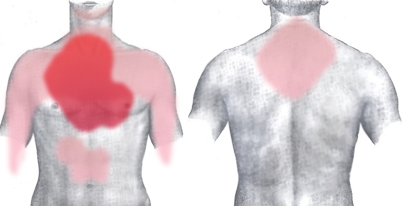 Angina (dor no peito) e radiação para diferentes zonas do corpo. Foto: Getty Images Angina - dor no peito e suas radiações