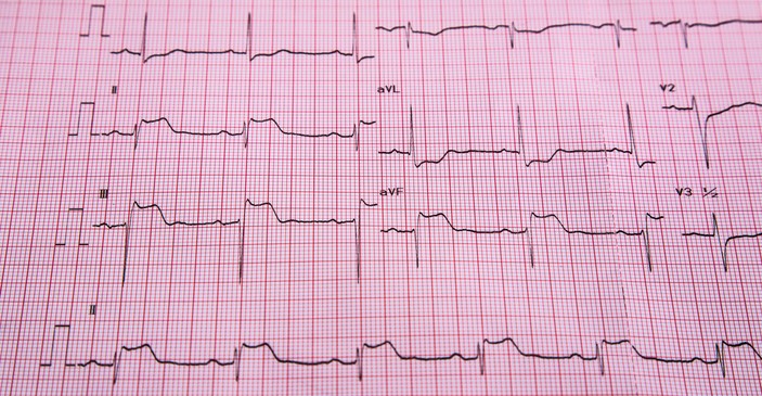 Sinais de enfarte do miocárdio no ECG Foto da fonte: Getty Images ECG - STEMI - sinais de elevação de ST e enfarte do músculo cardíaco