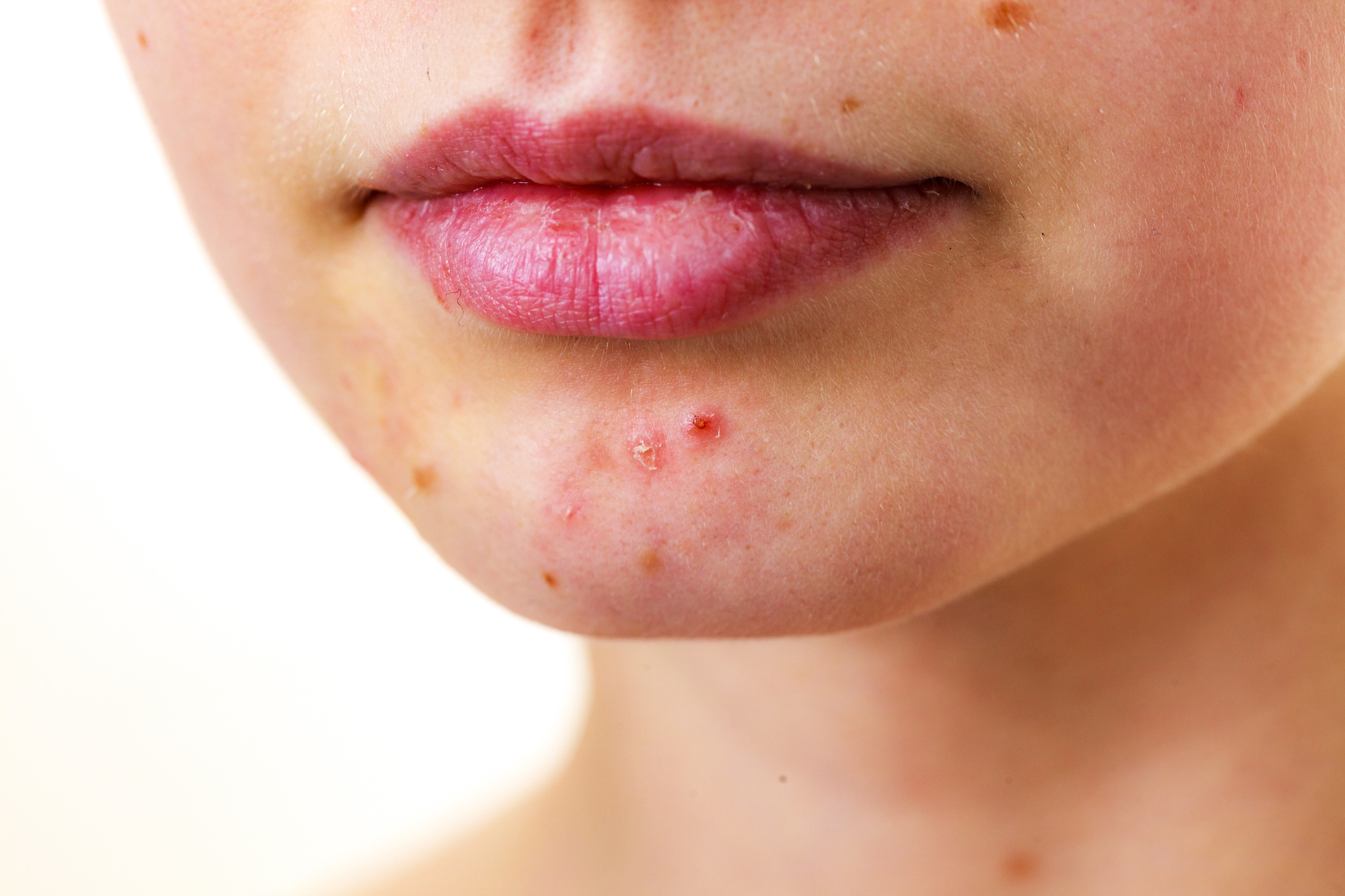 Inflamação da pele do queixo sob a forma de acne: Getty Images Acne no queixo de uma mulher - um olhar atento
