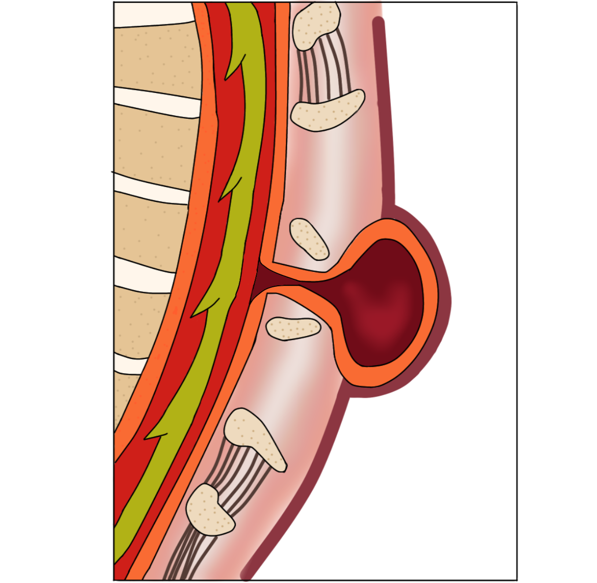 Meningocele, extrusão do invólucro da medula espinhal, sem danos na medula espinhal, que não deixa consequências permanentes após o tratamento. Meningocele