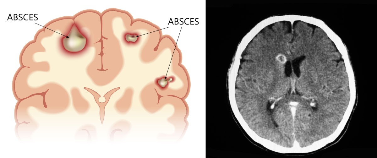 Imagens anatómicas e de TAC da lesão (dano) do cérebro Fonte: Getty Images Vistas anatómicas e TAC de um abcesso cerebral