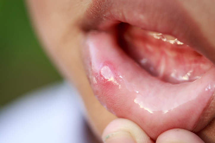 As aftas pequenas formam-se mais frequentemente na mucosa interna dos lábios Fonte: Getty Images Aphta no interior dos lábios da criança