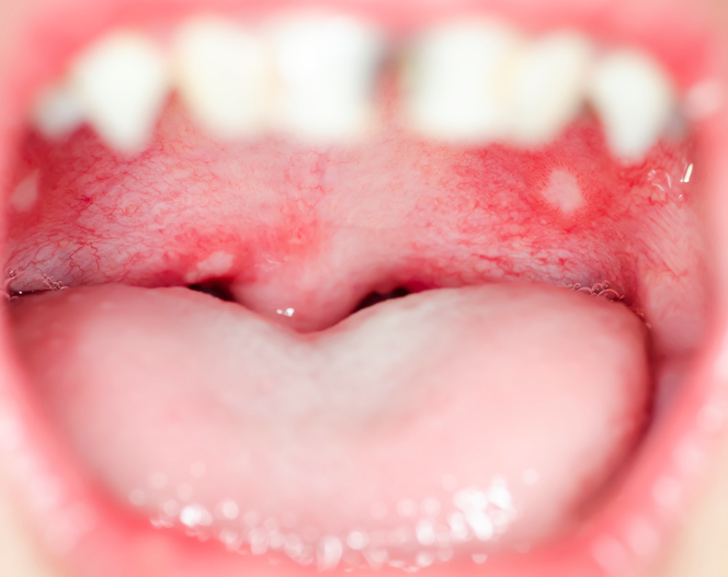 Aftas mais numerosas no palato mole Fonte: Getty Images Numerosas aftas na membrana mucosa do palato mole