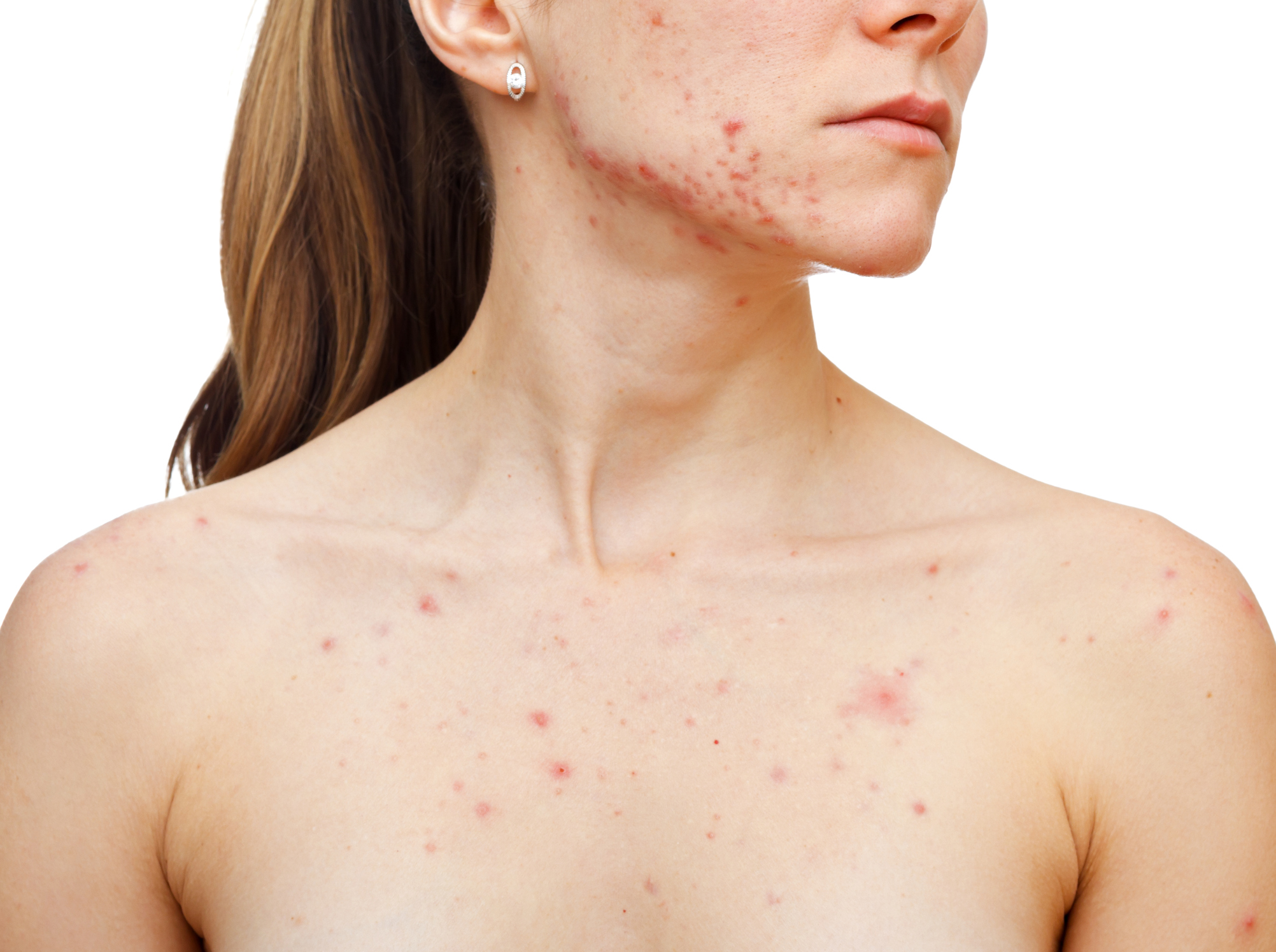 A acne afecta a pele e apresenta-se sob várias formas: Getty Images Acne no rosto e no peito de uma mulher