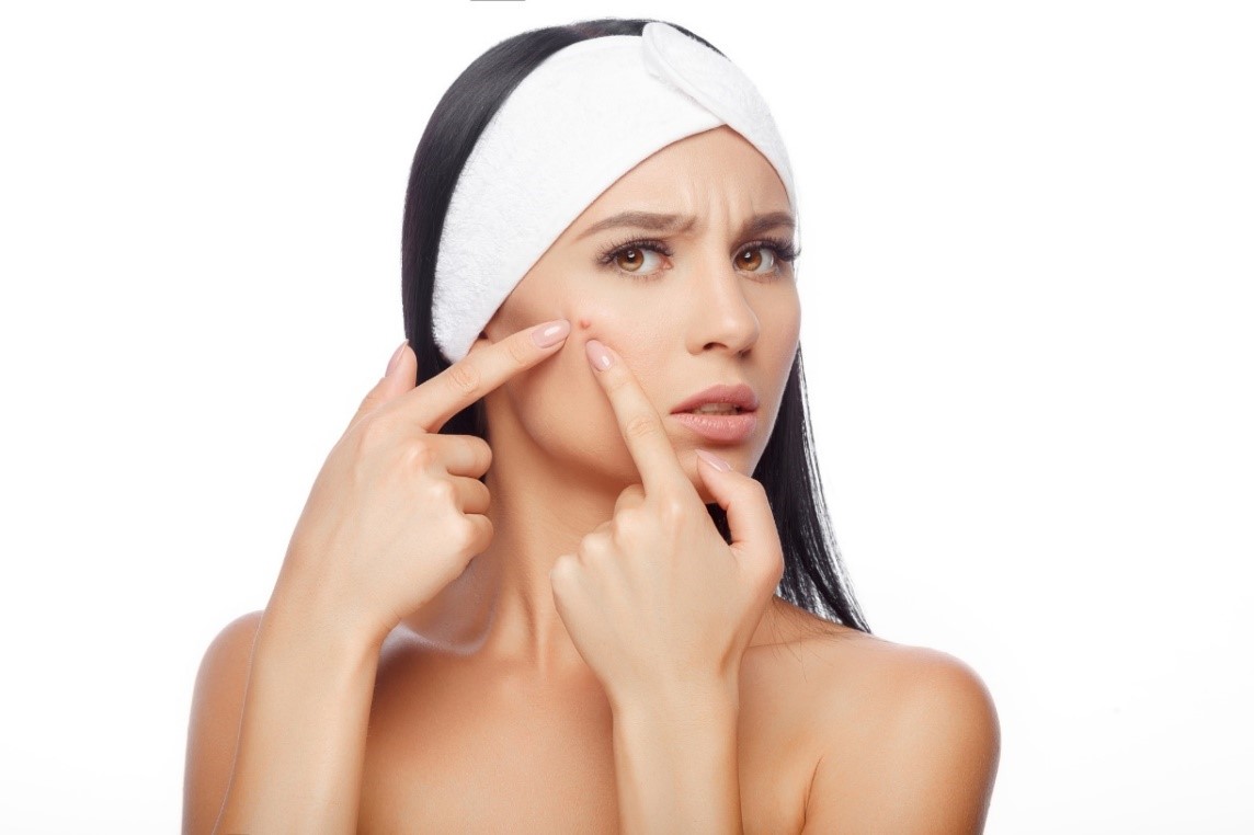 Espremer e coçar a acne é inadequado: Getty Images Uma mulher está a ficar com acne, o que é inadequado