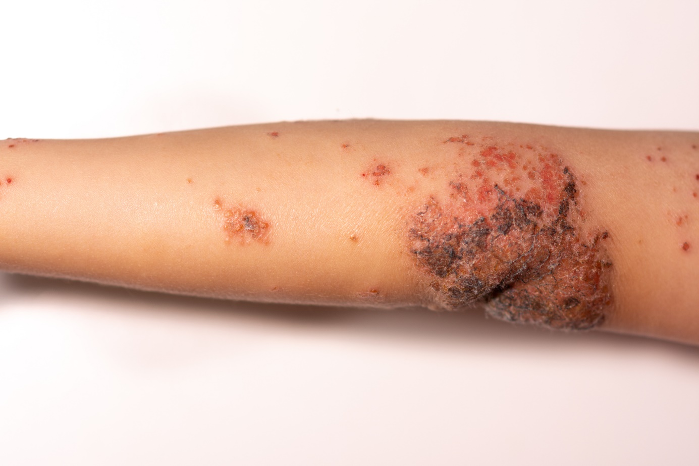 Um exemplo do aspeto do impetigo