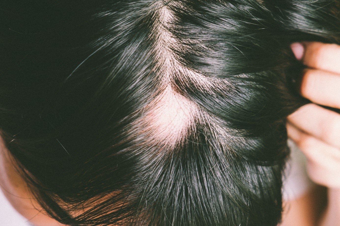 A condição de ter uma quantidade reduzida de cabelo ou cabelo: Getty Images Alopécia, cabeça, cabelo preto, condição de queda excessiva de cabelo