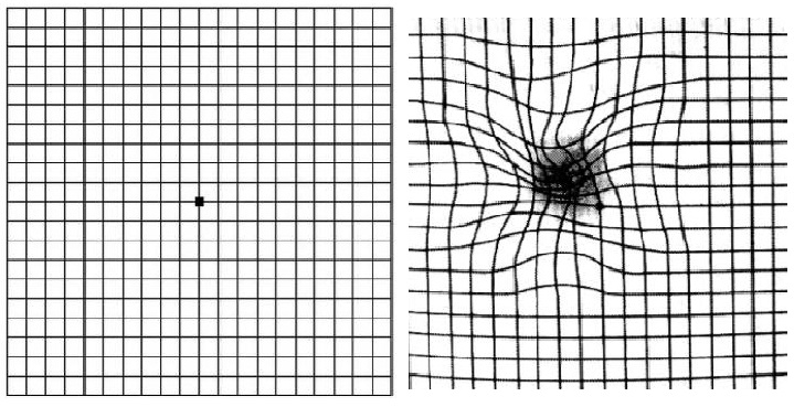Teste de Amsler - grelha na visão normal e à direita na degenerescência macular. Foto: http://en.wikipedia.org en.wikipedia Teste de Amsler - grelha na visão normal e à direita na degenerescência macular
