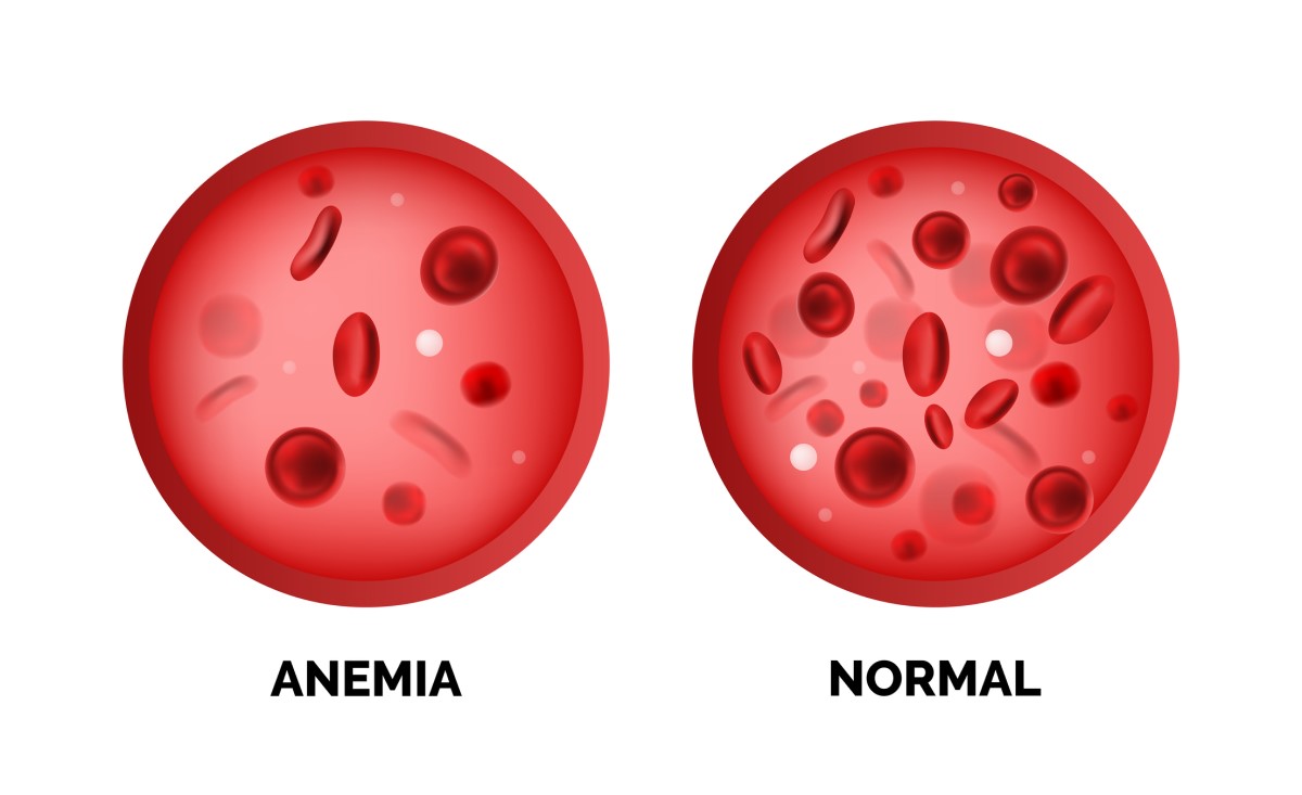 À esquerda, anemia = contagem reduzida de glóbulos vermelhos e à direita, normal: Getty Images Anemia e níveis normais de glóbulos vermelhos no sangue