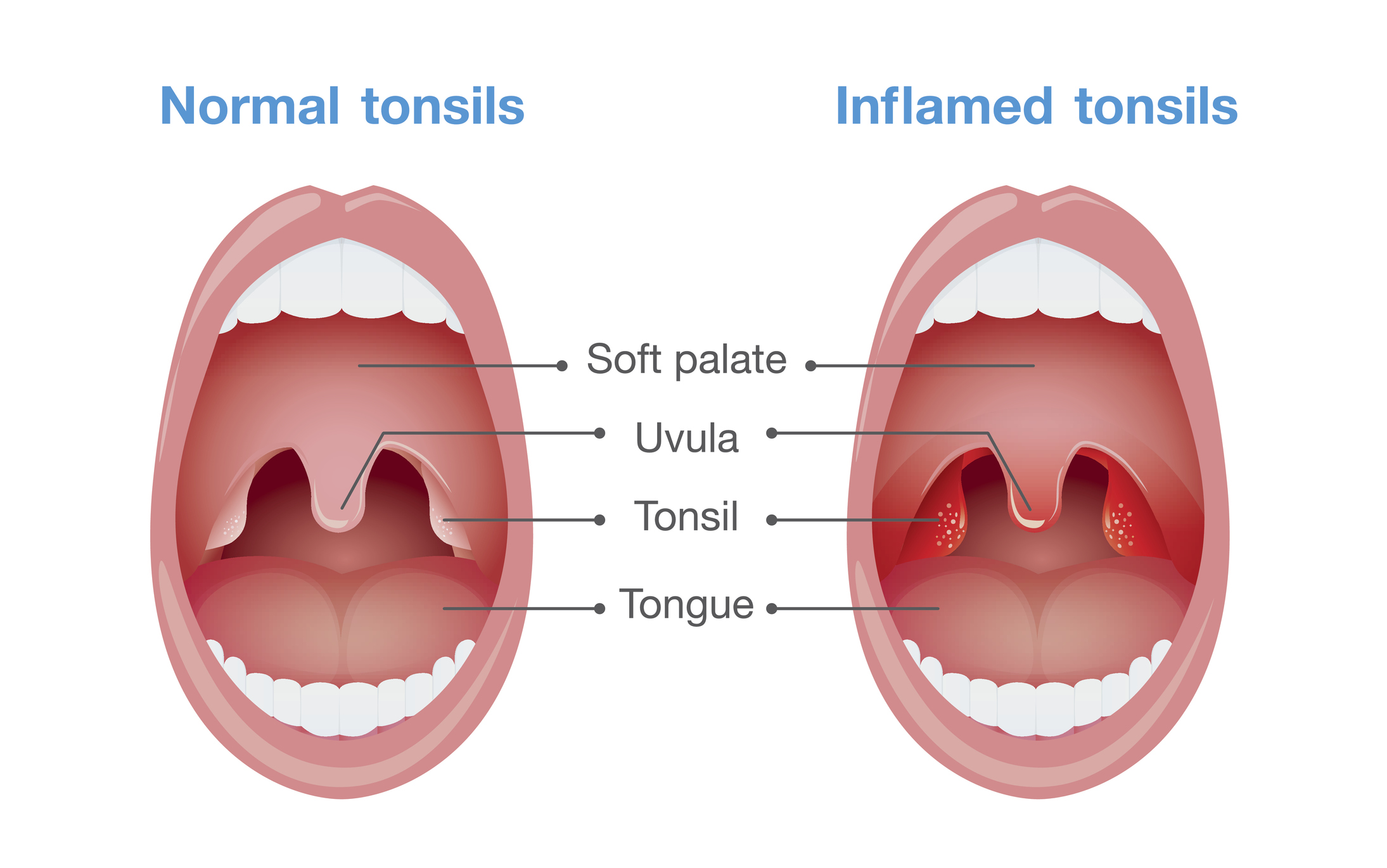 Angina - inflamação das amígdalas