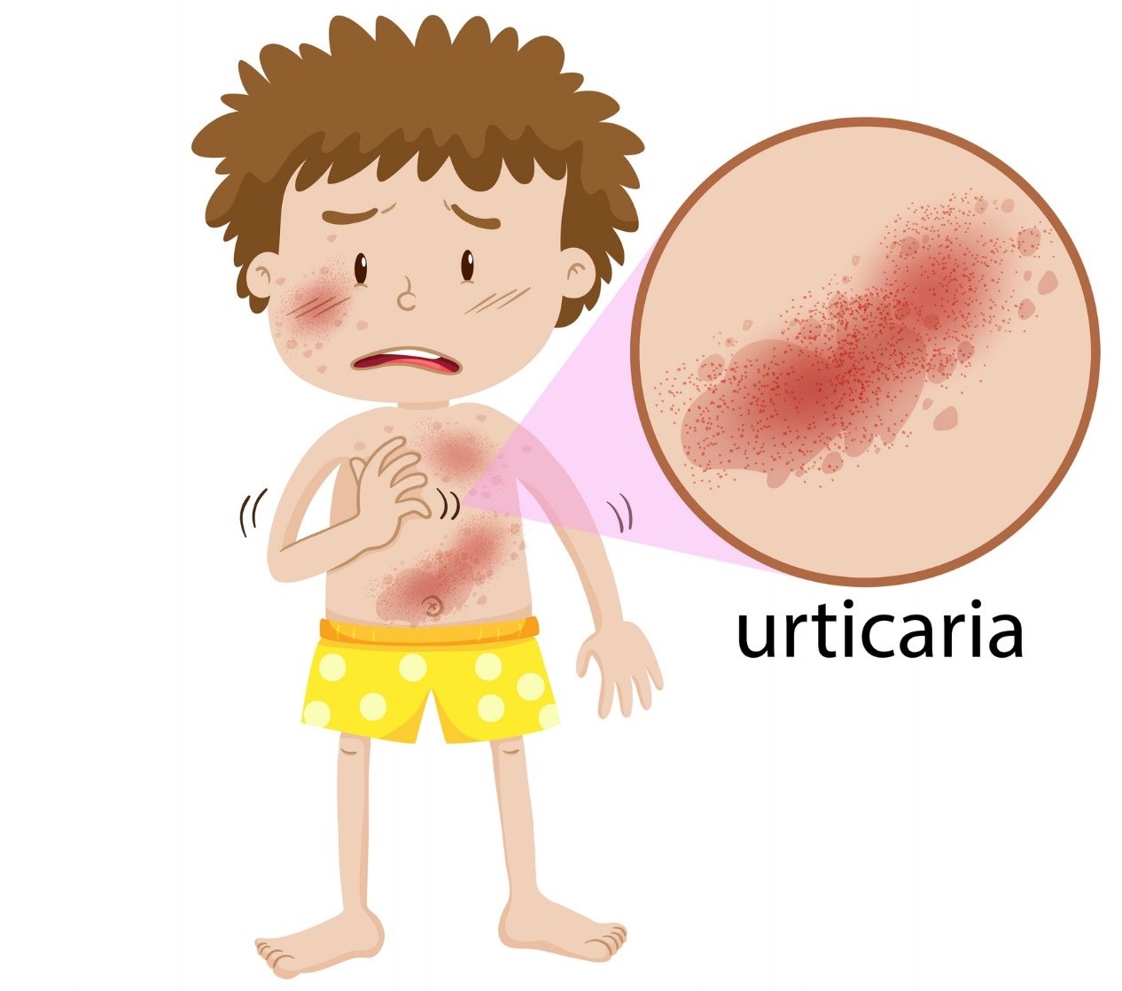 Urticária em todo o corpo sob a forma de inchaços circunscritos vermelhos: Getty Images Animação - um rapaz com uma erupção cutânea em todo o corpo, vermelhidão da pele, urticária