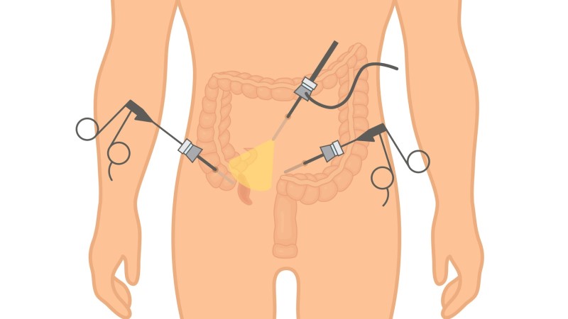 Laparoscopia para apendicite. Foto: Getty Images Representação do modelo de laparoscopia na apendicite