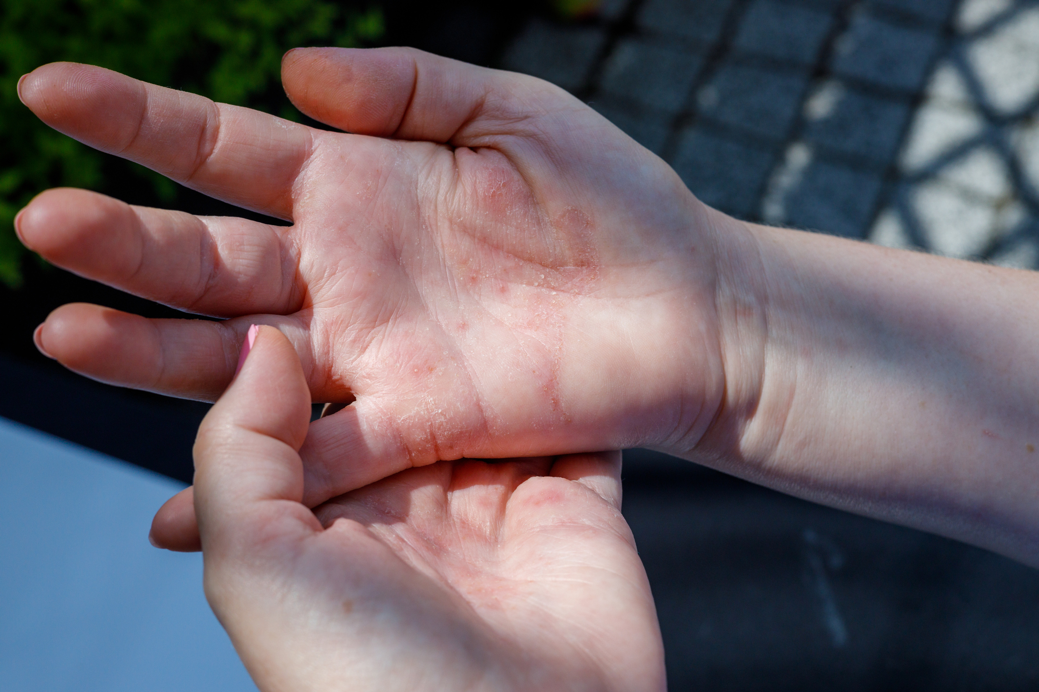 Eczema atópico em adultos Fonte: Getty Images Eczema atópico em adultos