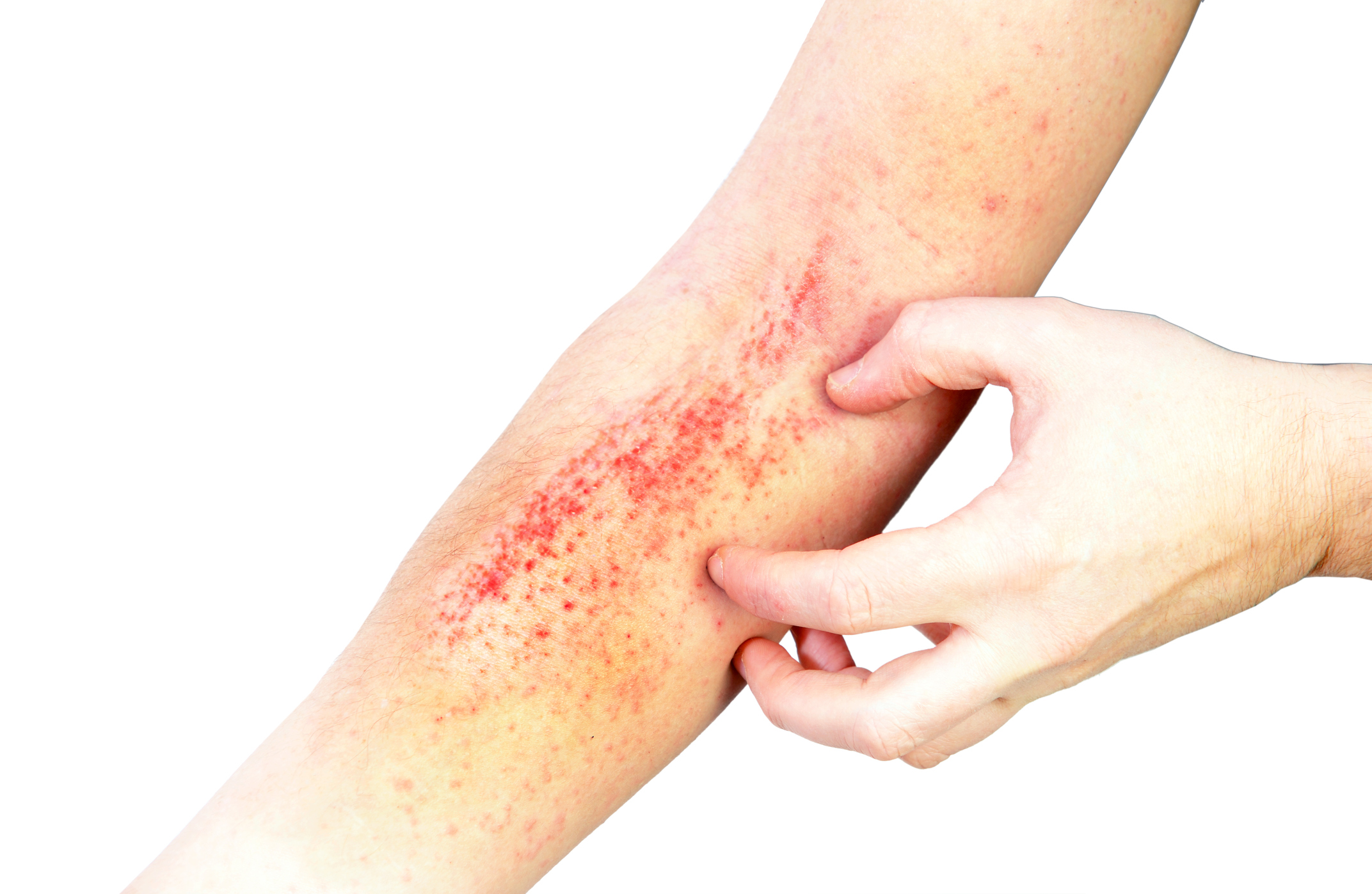 Arranhão no braço. Fonte: Getty Images Mancha na mão - eczema atópico
