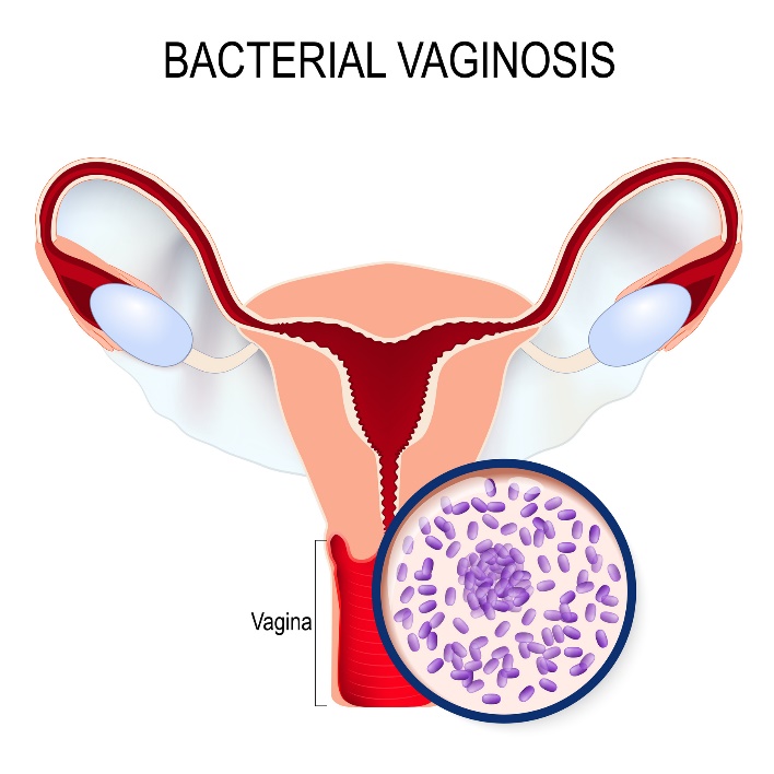 Vaginose bacteriana e crescimento excessivo de Gardnerella vaginalis: Getty Images Vaginose bacteriana e crescimento excessivo de Gardnerella vaginalis