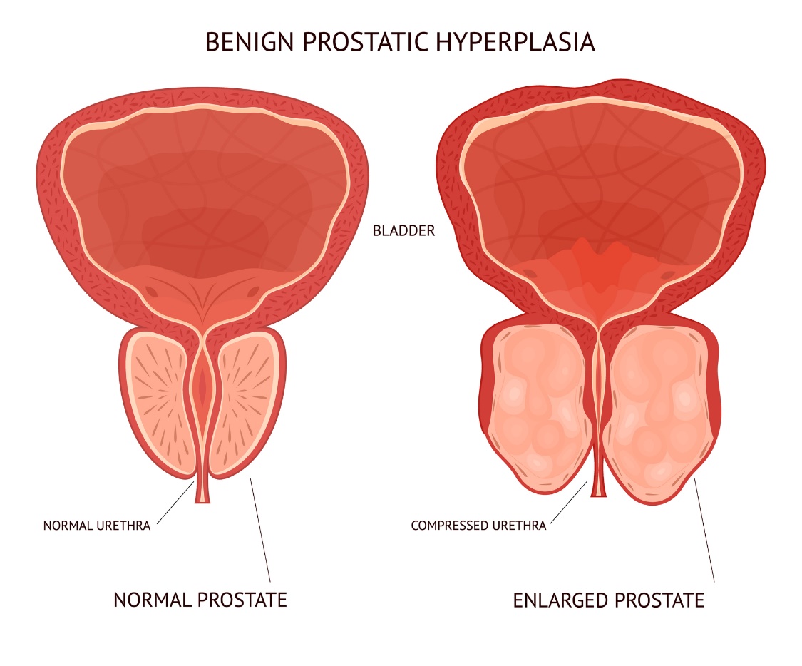 Hiperplasia prostática benigna. esquerda: tamanho fisiológico da próstata com função uretral normal. direita: próstata aumentada com subsequente opressão uretral. fonte: Getty Images Hiperplasia benigna da próstata