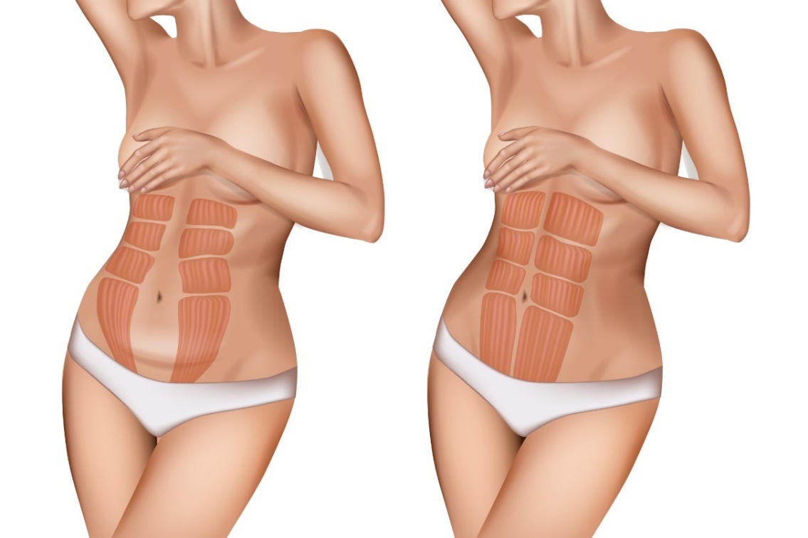 Diástase abdominal, foto de origem: Getty Images Diástase abdominal