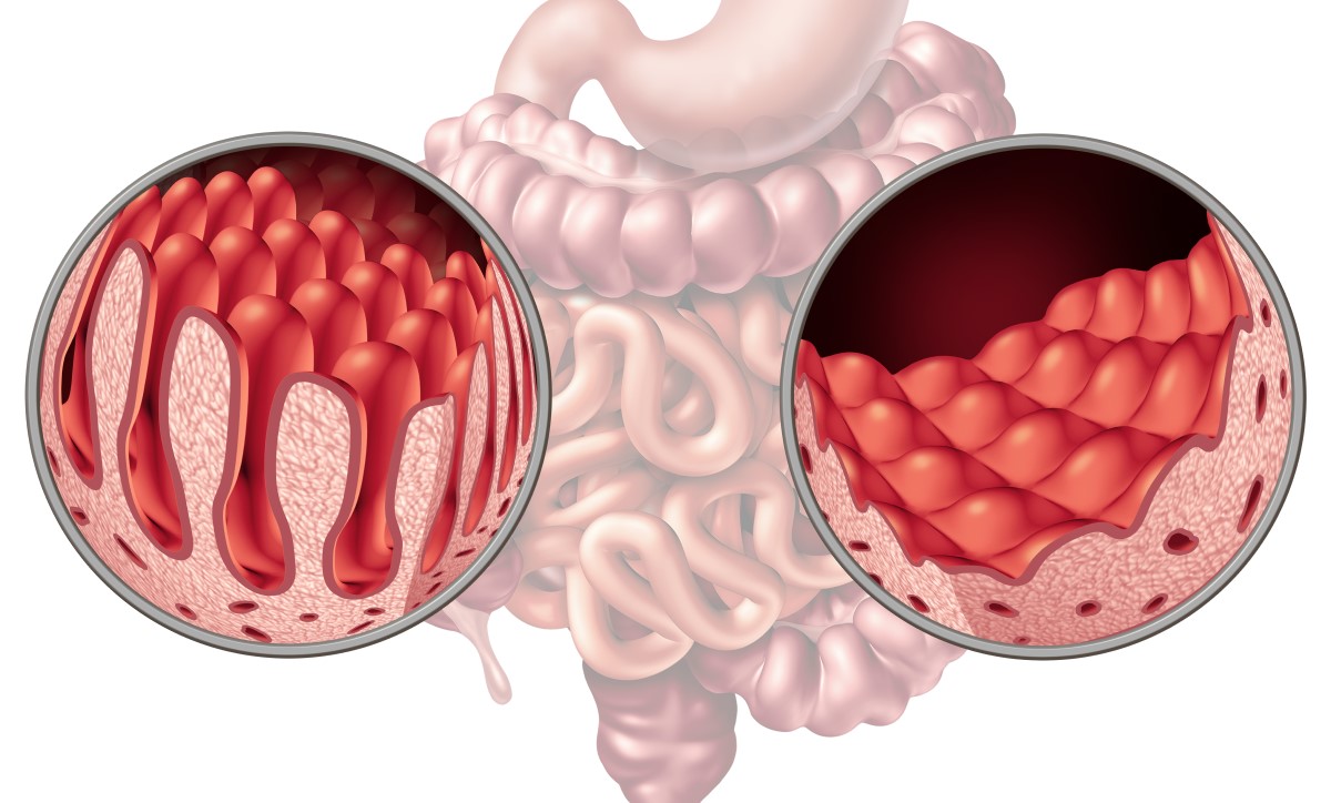 Intestino e vilosidades, onde os nutrientes são absorvidos, comparação: saudável e danificado pela doença celíaca