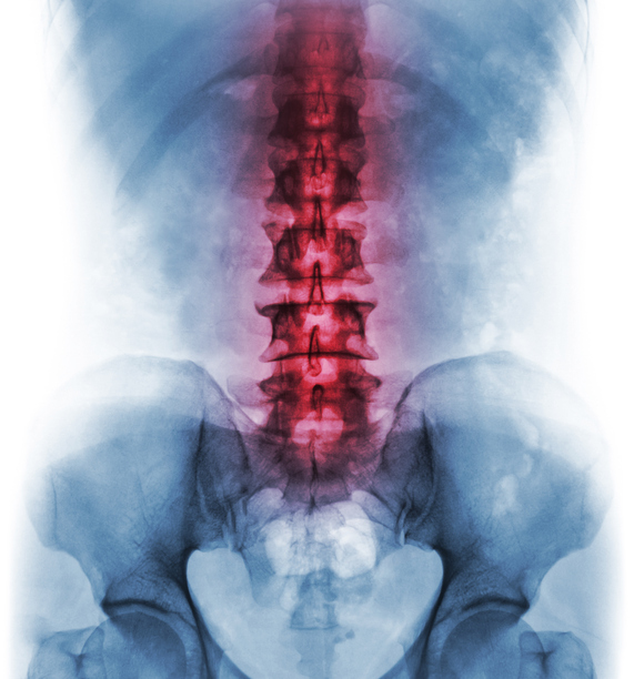 Dor típica na zona lombar. Fonte da foto: Getty Images Modelo da coluna vertebral e parte inferior realçada
