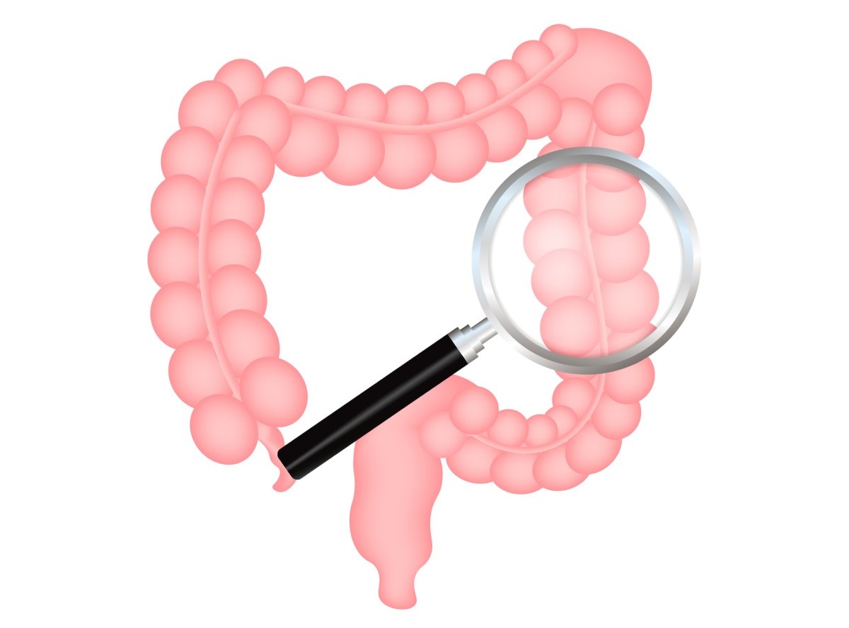 O tempo e a correcta diferenciação entre ileus e obstrução intestinal mecânica é um fator crucial para o diagnóstico: Getty Images Animação do intestino e da caspa como representação do diagnóstico de doenças intestinais