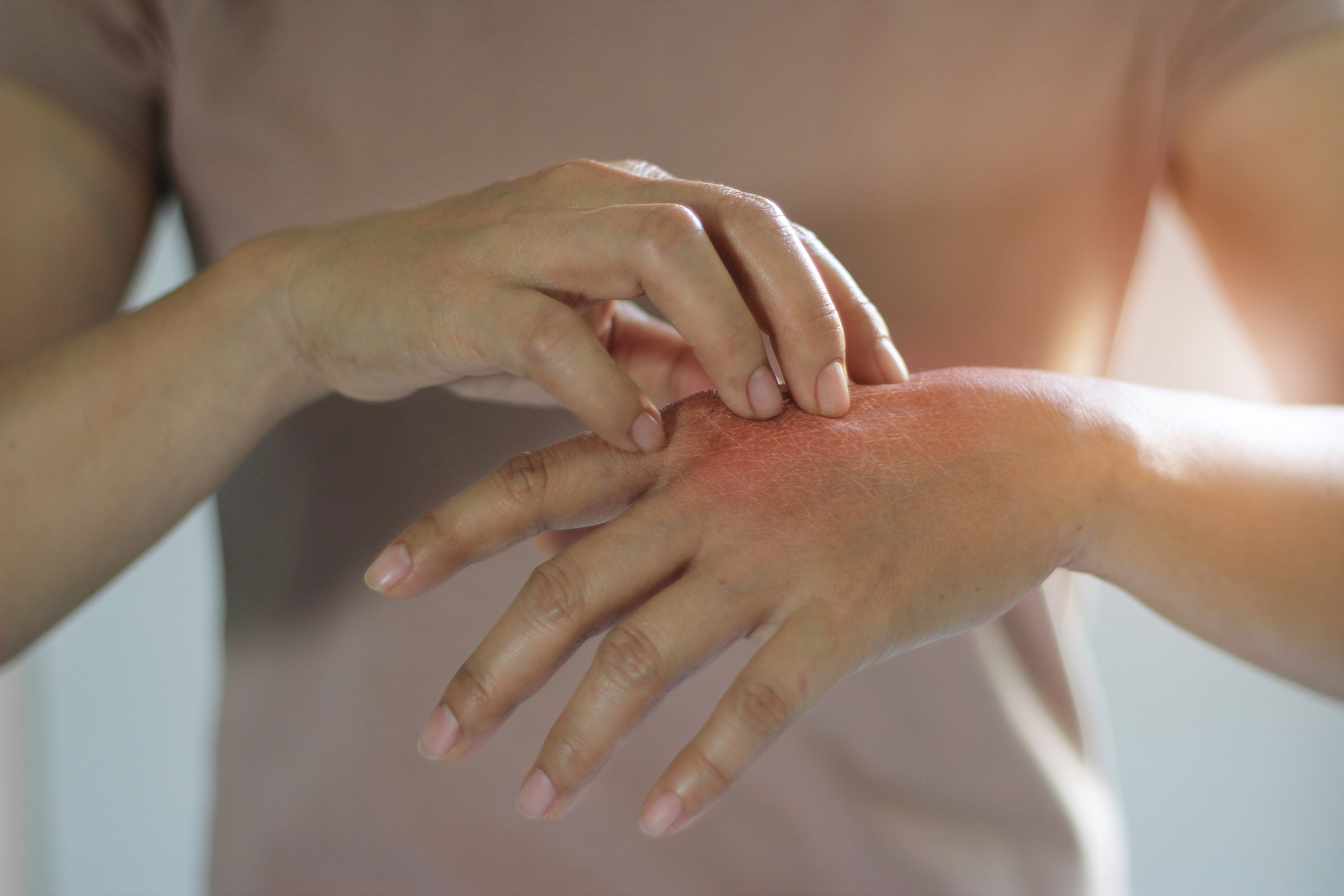 As causas da sensação de comichão podem ser diferentes - pele seca, alergia ao detergente ou ao detergente da loiça e dermatite: Getty Images Dermatite - comichão na pele