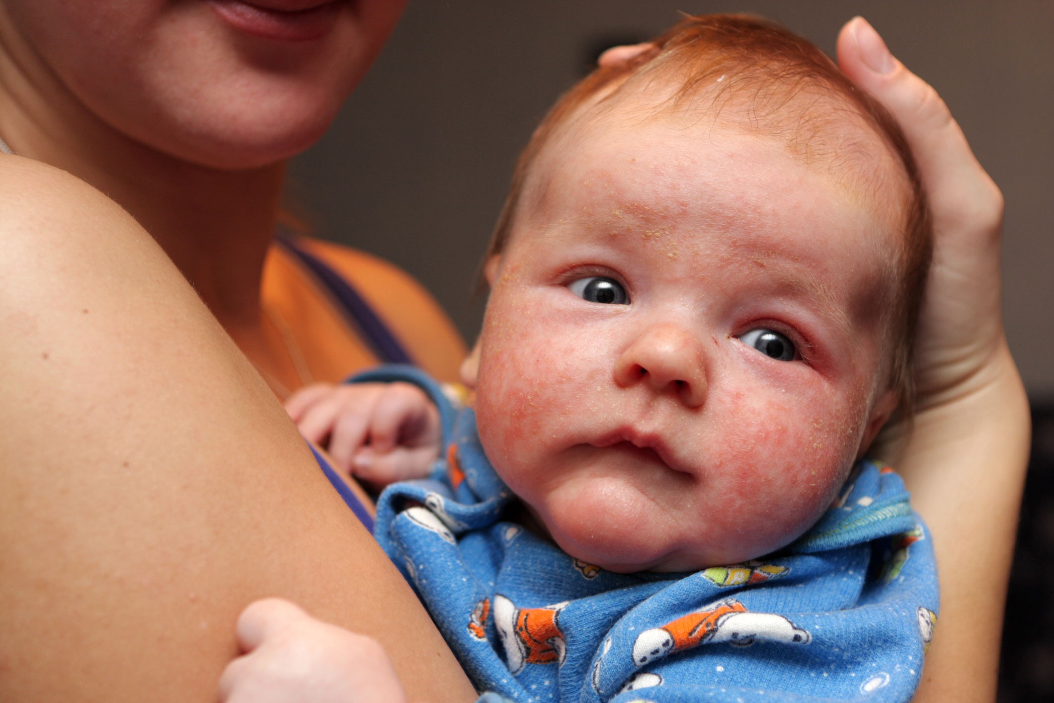 Dermatite no rosto de uma criança pequena: Getty Images Dermatite no rosto de uma criança pequena