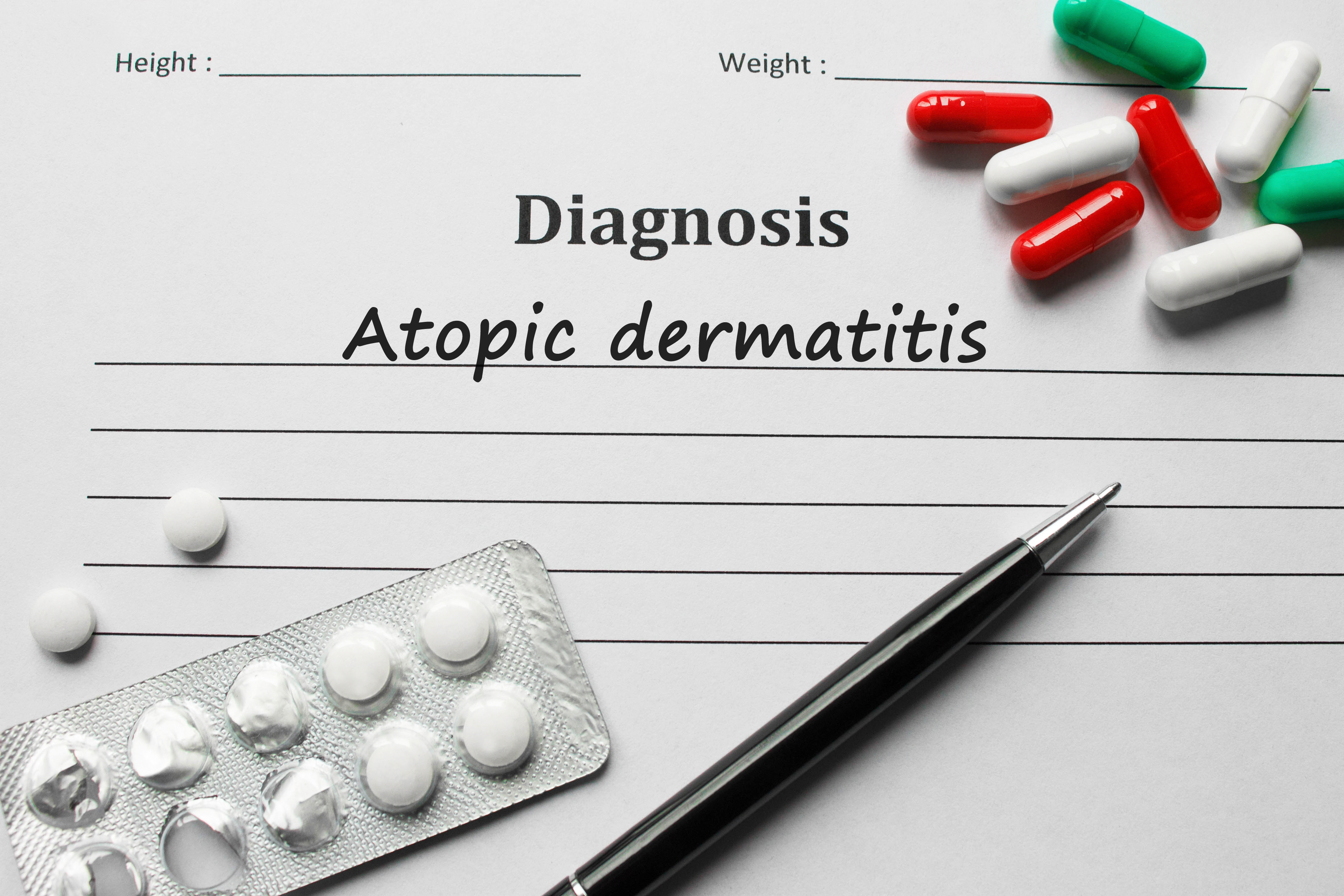 Diagnóstico da dermatite atópica Fonte: Getty Images Diagnóstico da dermatite atópica