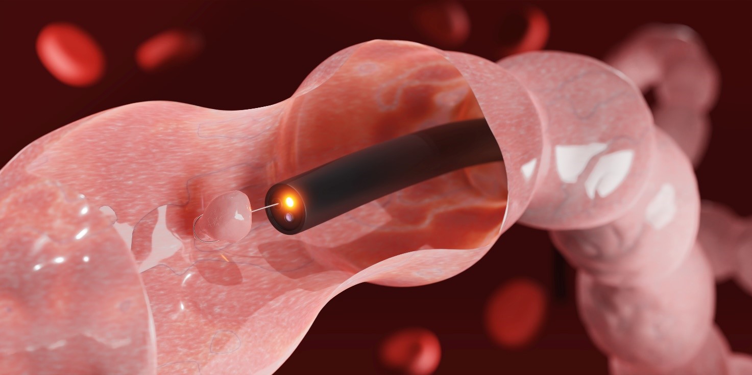 Colonoscopia com biópsia - recolha de uma amostra do pólipo Foto de origem: Getty Images Colonoscopia e biopsia do cólon e amostragem de pólipos