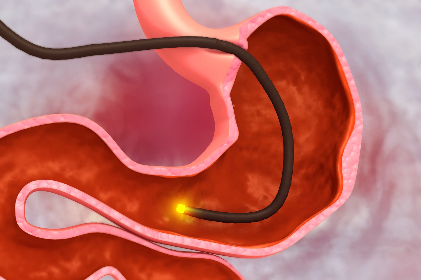 A endoscopia do tracto gastrointestinal superior é o método de diagnóstico preferido para diagnosticar doentes com suspeita de úlcera: Getty Images Endoscopia