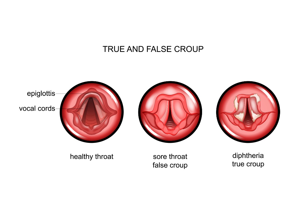 Difteria falsa e verdadeira: 1. Garganta saudável, 2. Garganta inchada e dolorosa, 3. Difteria verdadeira com a presença de pseudomembranas branco-acinzentadas Fonte: Getty Images Difteria falsa e verdadeira