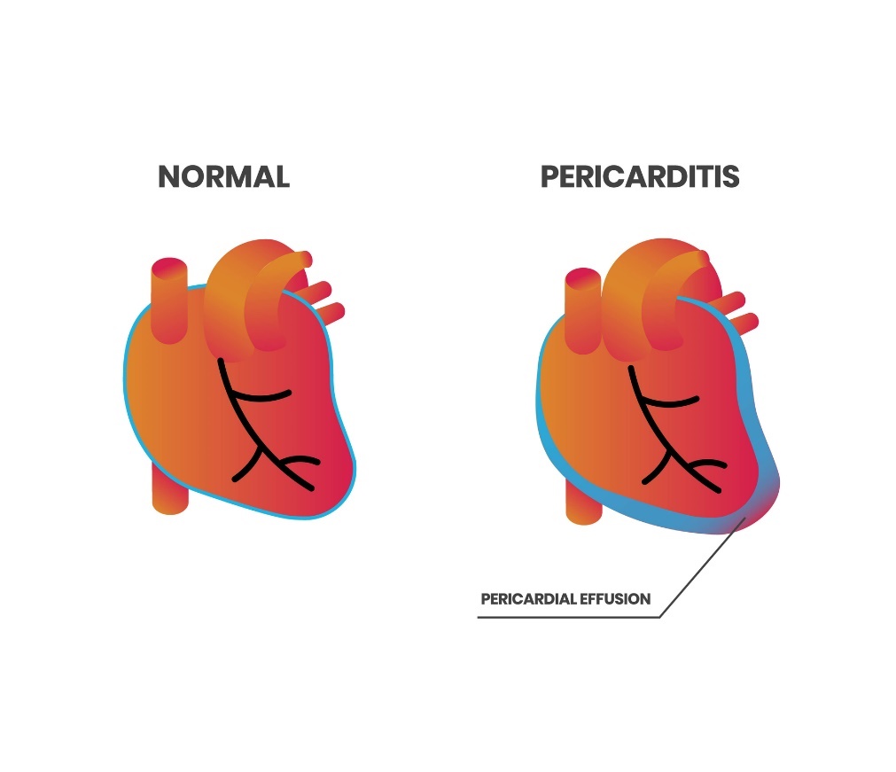 Fisiologia cardíaca e pericardite (derrame pericárdico) Fonte: Getty Images Fisiologia cardíaca e pericardite (derrame pericárdico)