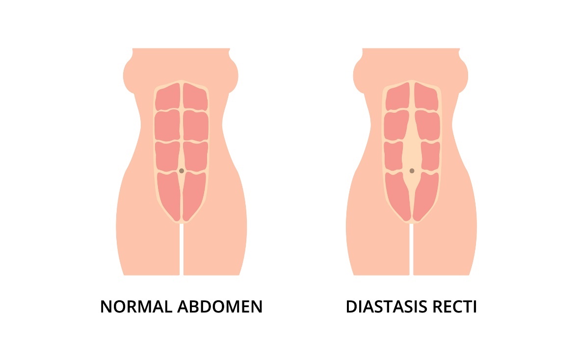 Estado fisiológico dos músculos abdominais e diástase (espaçamento) dos músculos rectos abdominais esquerdo e direito a partir da linha média, linha alba. Fonte da foto: Getty Images Estado fisiológico dos músculos abdominais e diástase (espaçamento) dos músculos rectos abdominais esquerdo e direito a partir da linha média da linha alba