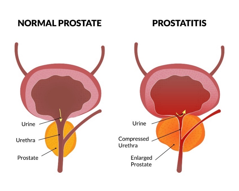 Fisiologia da próstata e prostatite: urina, uretra, próstata. uretra comprimida, próstata aumentada. fonte: Getty Images O estado fisiológico da próstata e a prostatite