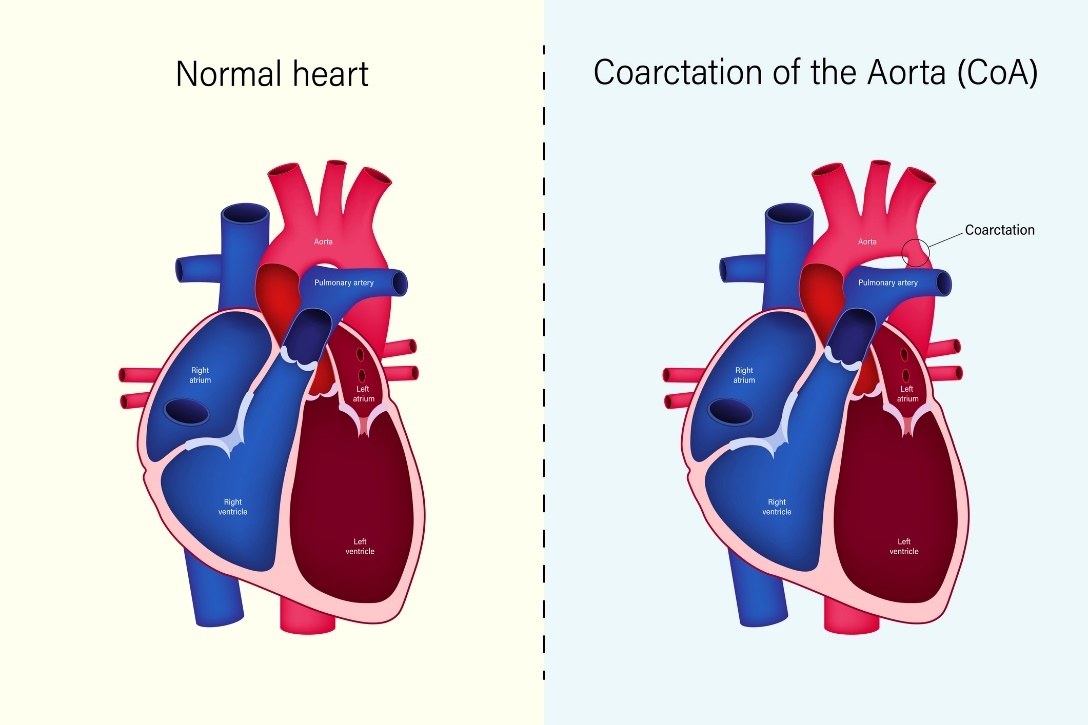 Estado fisiológico do coração e coartação da aorta (CoA) Fonte: Getty Images Estado fisiológico do coração e coartação da aorta (CoA)
