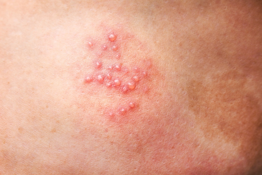 Herpes genital - imagem real. Pequenas bolhas cheias de líquido características: Getty Images Herpes genital