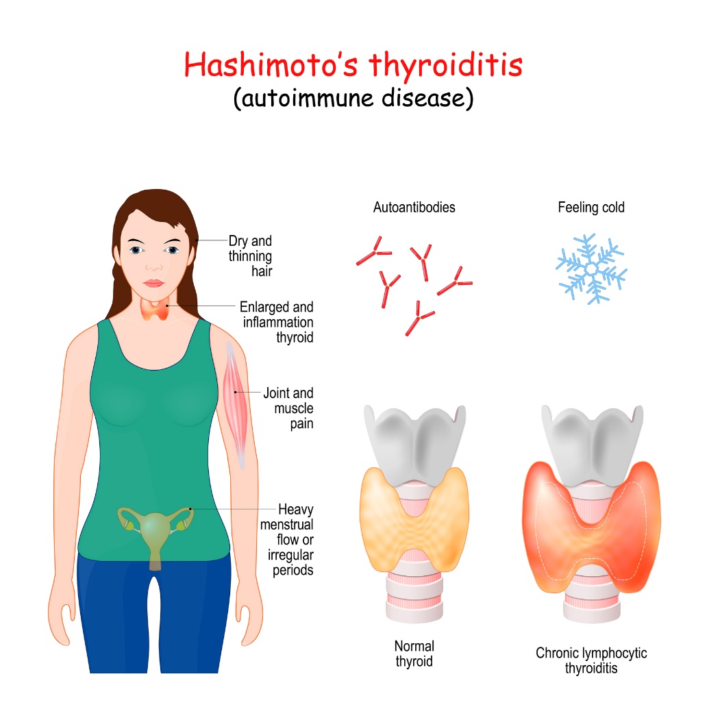 Tiroidite de Hashimoto e sintomas clínicos: cabelo seco e ralo, aumento da glândula tiroide, dores articulares e musculares, hemorragias menstruais abundantes, calafrios: Getty Images Tireoidite de Hashimoto e sintomas clínicos