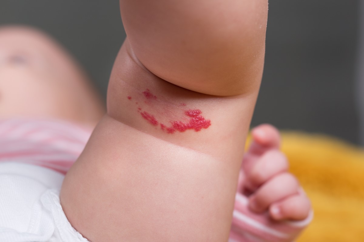 Hemangioma na coxa de uma criança: Getty Images Hemangioma na parte interna da coxa de uma criança