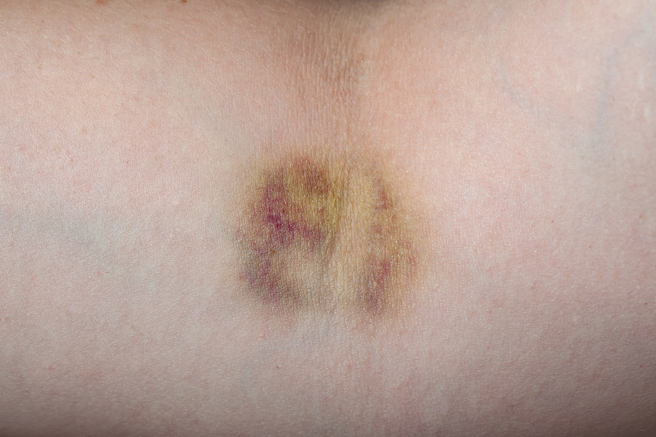 Hematoma (contusão) Fonte: Getty Images Hematoma (contusão)