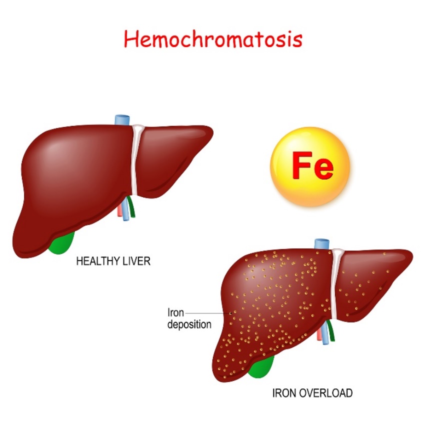 Hemocromatose: fisiologia e patologia do fígado com deposição excessiva de ferro (Fe)
