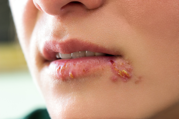 Herpes que afecta a pele do canto da boca. Fonte da fotografia: Getty Images Herpes simplex no rosto - lábios e canto da boca