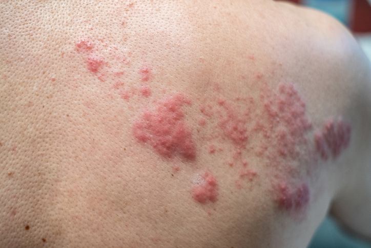 O tratamento tem como objetivo evitar a propagação, a progressão e as complicações da doença. zona das costas. fonte da foto: Getty Images Herpes zoster nas costas