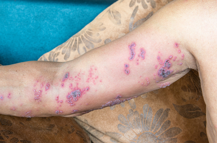 Riscas no membro superior. Fonte da fotografia: Getty Images Herpes zoster na cóclea superior