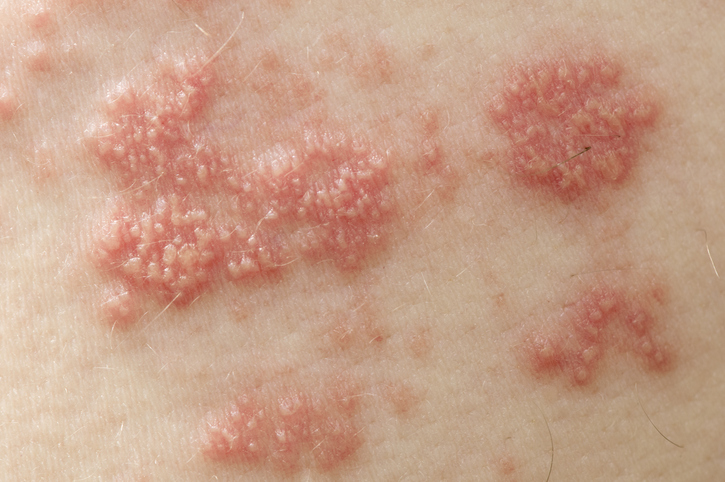 O vírus da varicela zoster propaga-se mesmo a partir de bolhas na pele. Fonte da foto: Getty Images Bolhas de herpes-zóster na pele, cheias de líquido que contém o vírus