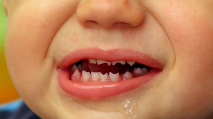 Os dentes de Hutchinson Foto de origem: Healthline.com Os dentes de Hutchinson