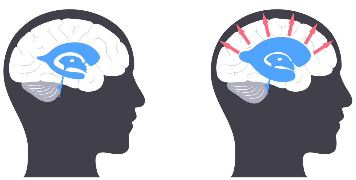 À esquerda está o estado normal e à direita as setas mostram a pressão dos ventrículos sobre o tecido cerebral: Getty Images Cabeça com cérebro - à esquerda - cérebro normal / à direita - cabeça com cérebro com hidrocefalia, em que as setas do centro para fora indicam o alargamento dos ventrículos cerebrais e a pressão sobre o tecido cerebral.