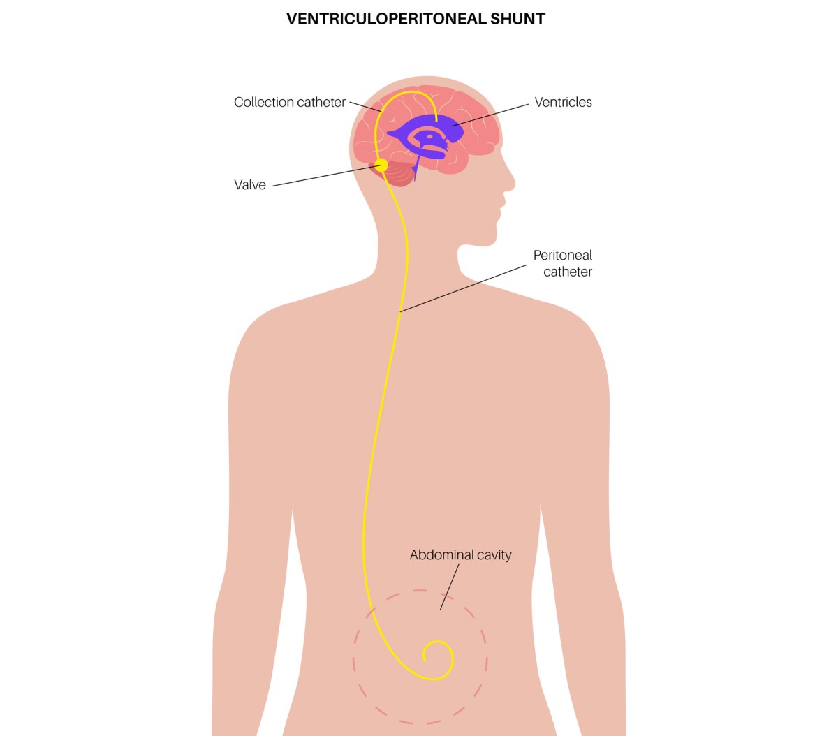 A derivação dos ventrículos conduz à cavidade abdominal, onde drena o excesso de líquido. Ventriculoperitoneal (derivação ventriculoperitoneal, Cateter de recolha / Válvula / Ventrículos / Cateter peritoneal / Cavidade abdominal) Fonte Getty Images Ilustração de uma derivação ventrículo-abdominal que drena o excesso de líquido do cérebro para a cavidade abdominal.
