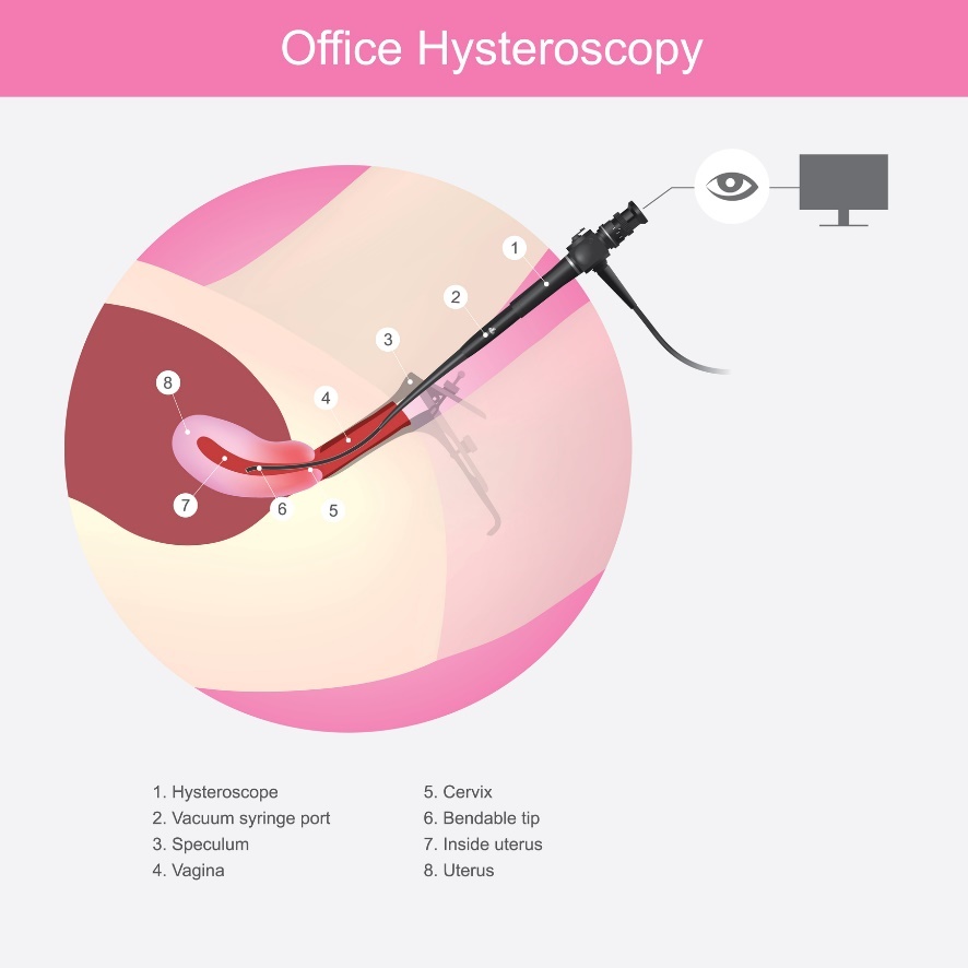 Histeroscopia: método diagnóstico e cirúrgico dos miomas uterinos. 1- histeroscópio, 2- porta para tubo de vácuo, 3- espelho, 4- bainha, 5- colo do útero, 6- ponta flexível, 7- interior do útero, 8- útero: Getty Images Histeroscopia