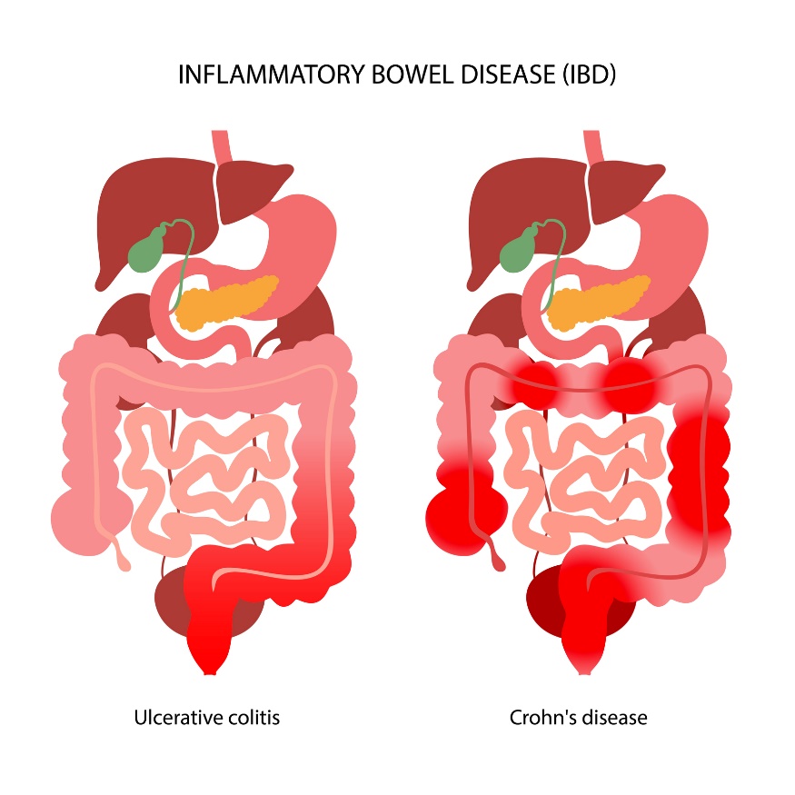 DII: Divisão em colite ulcerosa e doença de Crohn de acordo com a localização da reação inflamatória: Getty Images DII: Divisão em colite ulcerosa e doença de Crohn de acordo com a localização da reação inflamatória.