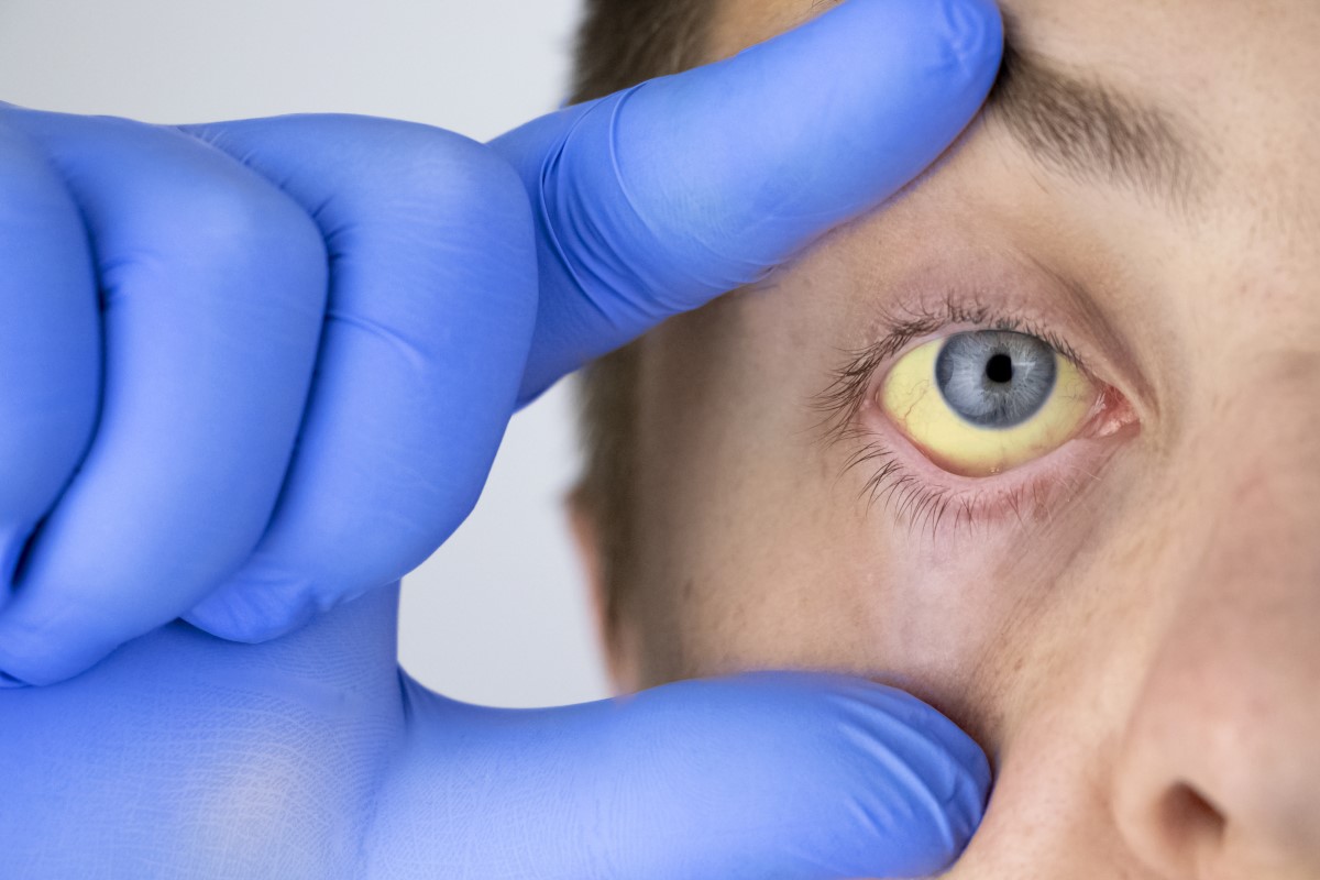 A iterícia, ou seja, a iterícia e o branco amarelo dos olhos, é um dos sintomas da disfunção hepática: Getty Images Icterícia, iterícia - branco dos olhos amarelado como sinal de uma função hepática deficiente.