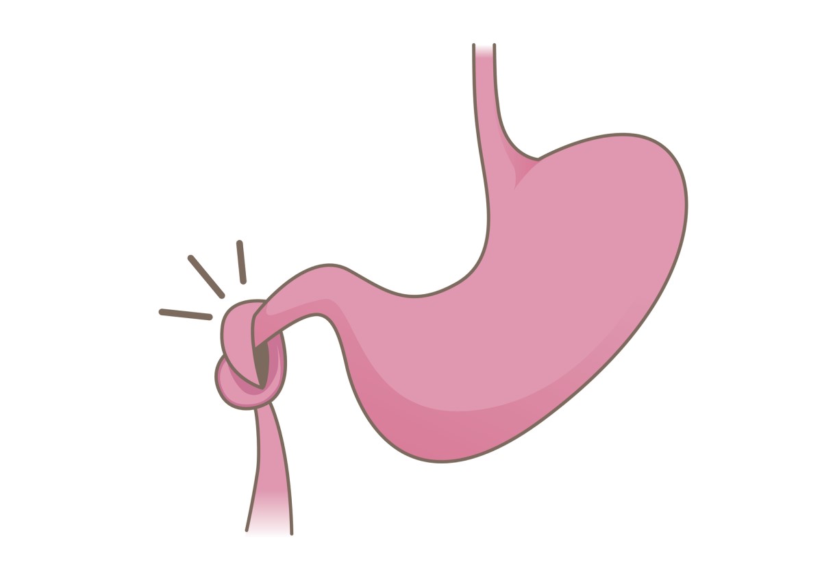 A obstrução intestinal é causada por uma obstrução mecânica. O íleo é causado por um mau funcionamento do peristaltismo intestinal, ou seja, é uma obstrução sem causa mecânica: Getty Images animação de intestino estrangulado e obstrução intestinal - íleo do intestino delgado e estômago sobre o intestino.